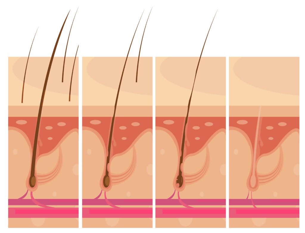 Can Hair Transplants Alter Your Hair Texture? A Comprehensive Guide